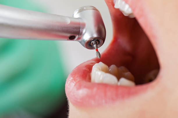 Best Emergency Root Canal Treatment in Nicholls, GA